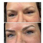 Can Local Anaesthetic Cause Facial Asymmetry During Lip Blush?