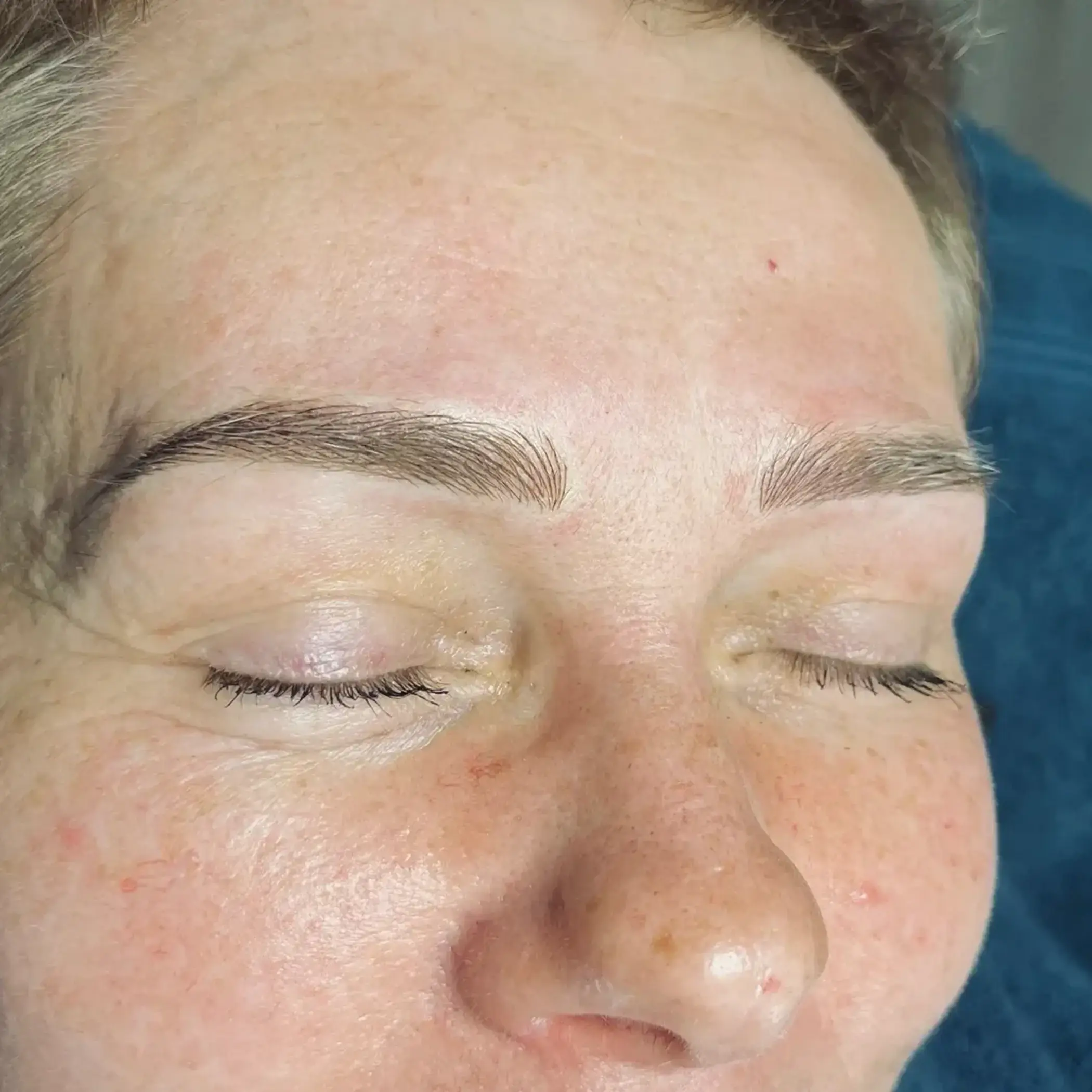 close up folliculitis after microneedling